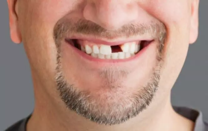 Reljefni prednji zub