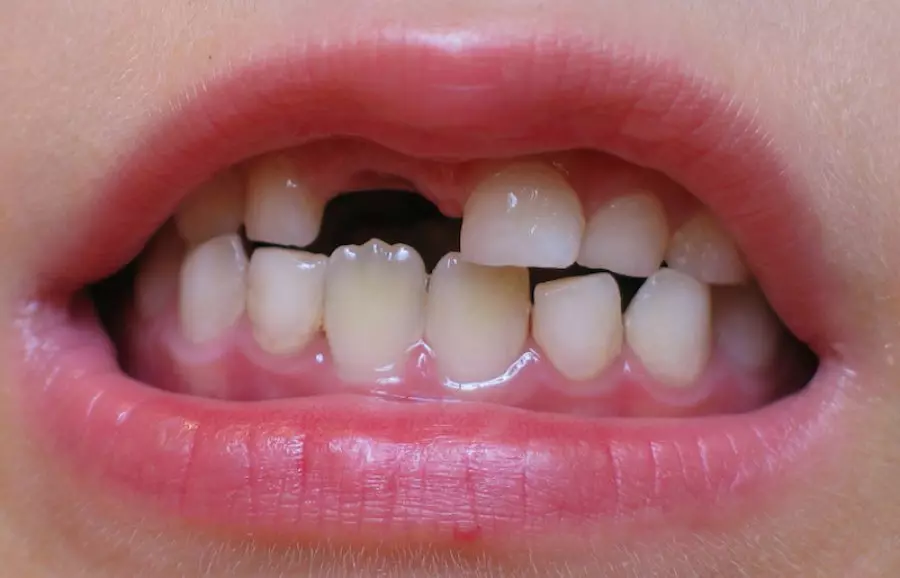 Gevallen tand van een kind