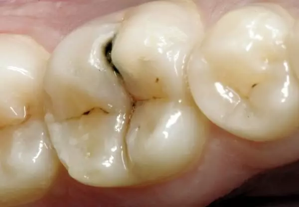 Zerrissener Zahn
