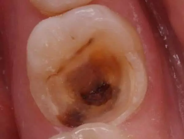 سوراخ در دندان