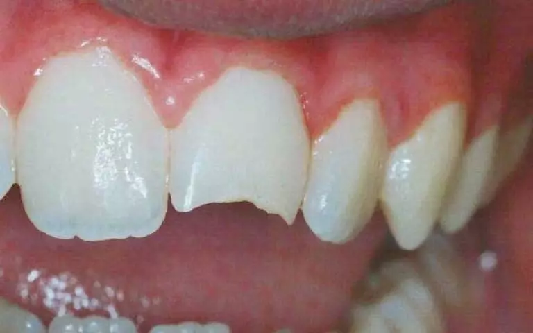 UPaul Teeth