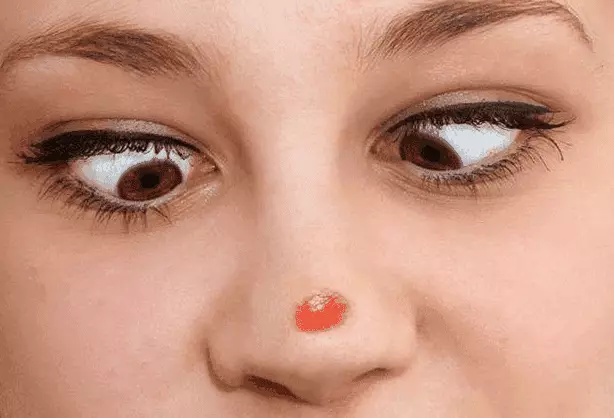 Signe: Pimple sur le nez ou le nez 7729_2